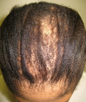 patch in hair loss